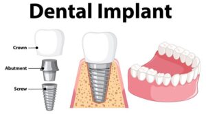 dental implants