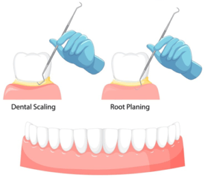 scaling & polishing