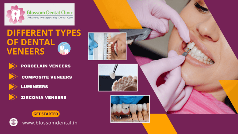 The Ultimate Guide to Different Types of Dental Veneers