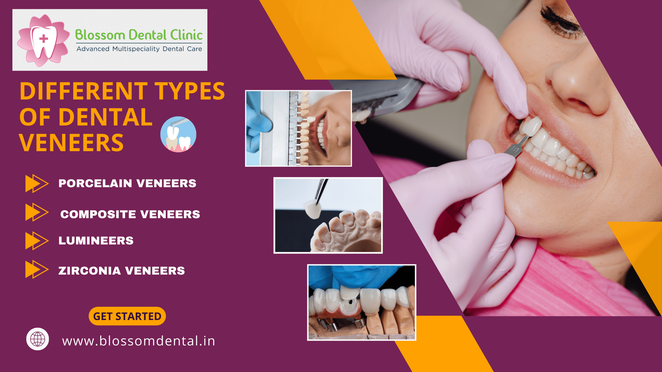 Types of Dental Veneers